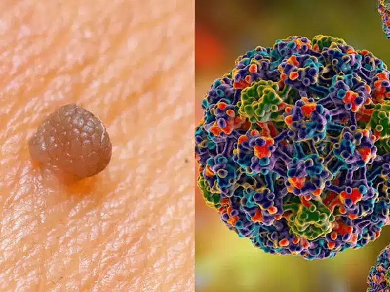 HPV Belirtileri Kadında