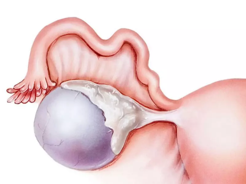 Bartholin Kisti Görüntüsü