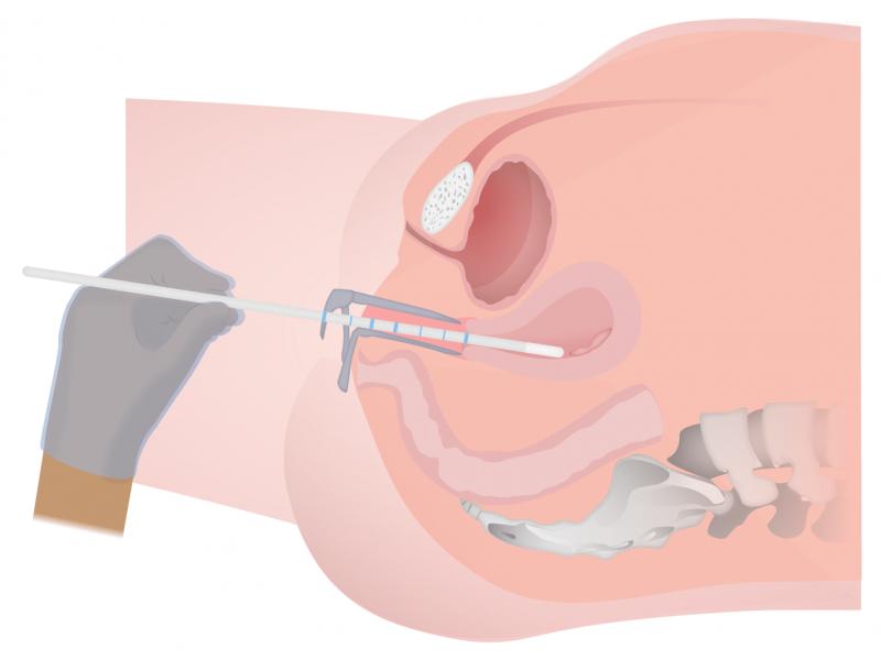 Genital PRP (O Shot)